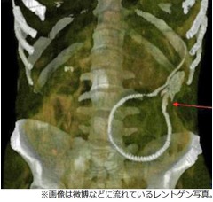 “尻にうなぎ挿入”で緊急手術、ネットでは「自業自得」と呆れる声。