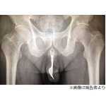 尿道にフォーク挿入で抜けず、豪州の70歳男性が救急搬送される事態に。