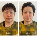 ノンスタ井上“顔の美容施術”のビフォーアフター公開、「すごい！顔が違う…」と反響