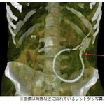 “尻にうなぎ挿入”で緊急手術、ネットでは「自業自得」と呆れる声。