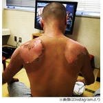 あばれる君の痛々しい日焼け、背中の皮が激しくむけた姿に心配の声。